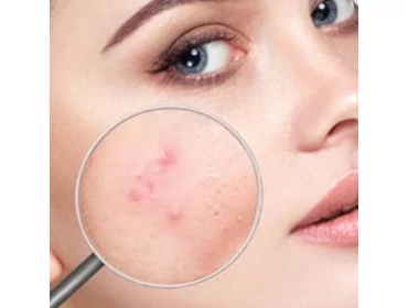 Aknés bőr kezelése