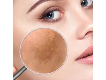 Elszíneződések, pigmentfoltok